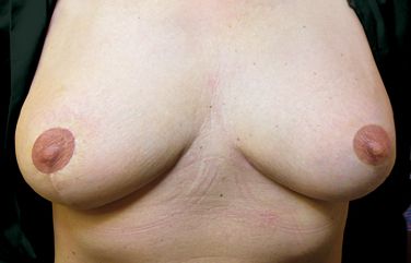vorhandenen Brustwarze zur Mamillenmitte