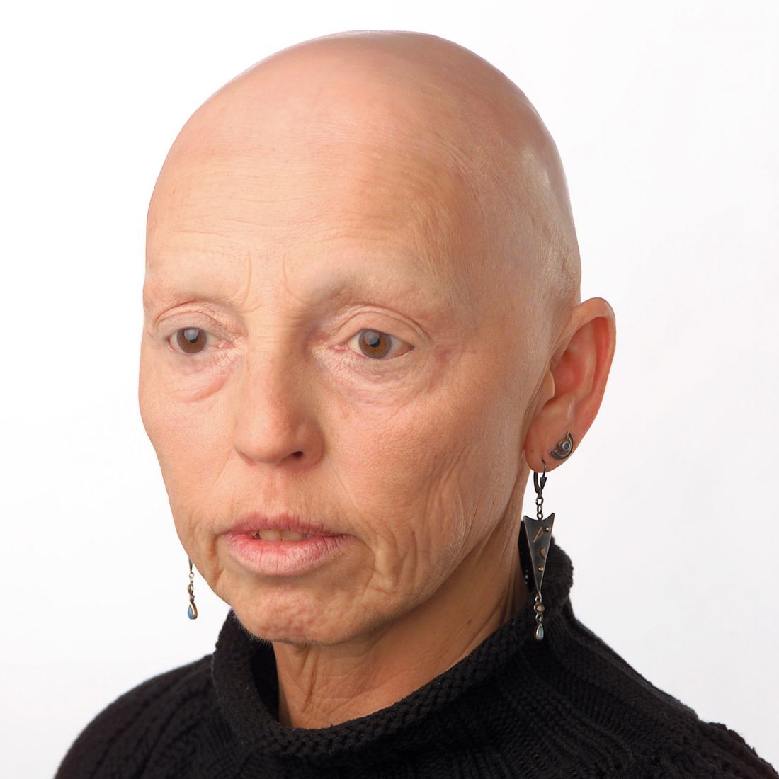 Haarlosigkeit nach Chemotherapie