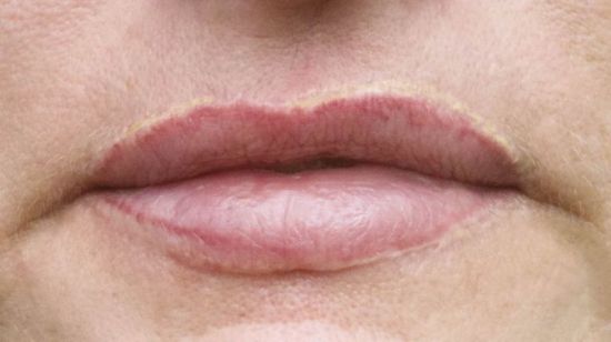Narben rund um die Lippen